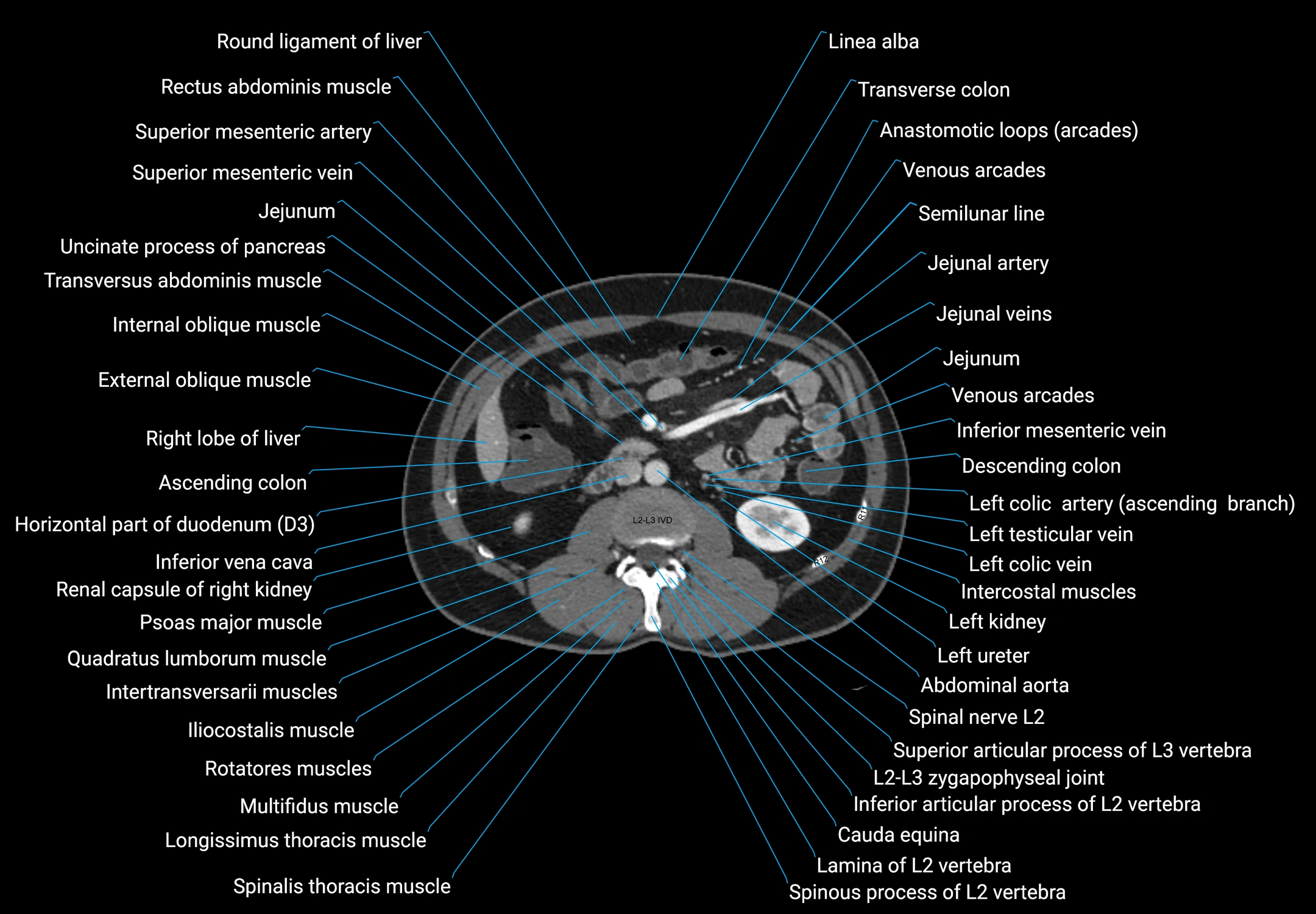 CT male pelvis axial cross sectional anatomy labelled radiology image -00082.webp